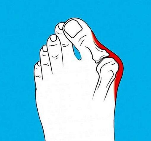 arthrosis ของข้อต่อบนนิ้วเท้า