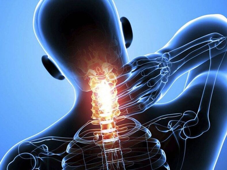 Osteochondrosis ของกระดูกสันหลังส่วนคอมาพร้อมกับอาการปวดคอ