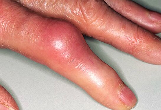 โรคเกาต์มาพร้อมกับความเจ็บปวดที่คมชัดในนิ้วมือและอาการบวมของข้อต่อ