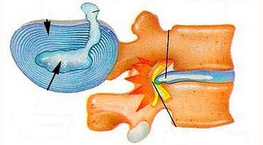 คุณสมบัติของการพัฒนาของ osteochondrosis ปากมดลูก